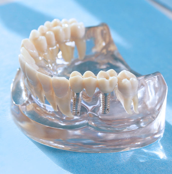 Zahnimplantate Gerlingen-Gehenbühl: feste und schöne Zähne
